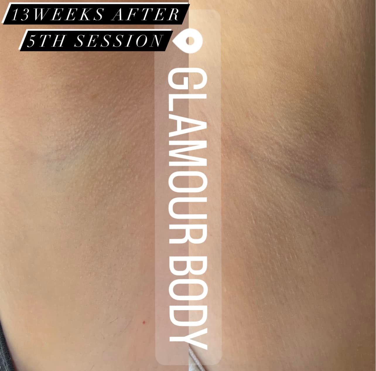 Laser Hair Removal Services In Camberley, UK