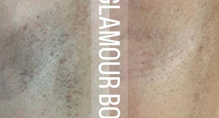 Laser Hair Removal Services In Camberley, UK